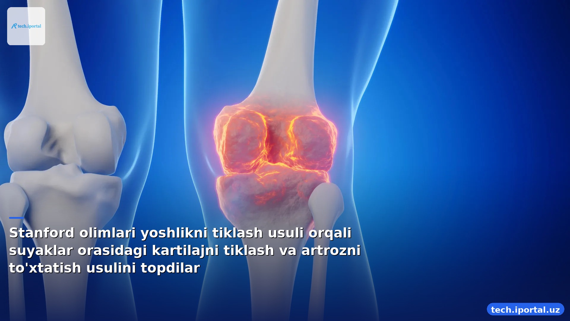 Stanford olimlari yoshlikni tiklash usuli orqali suyaklar orasidagi kartilajni tiklash va artrozni to'xtatish usulini topdilar